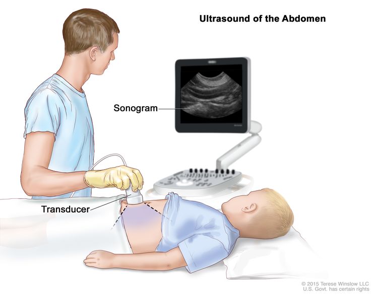 abdominal cancer in child)