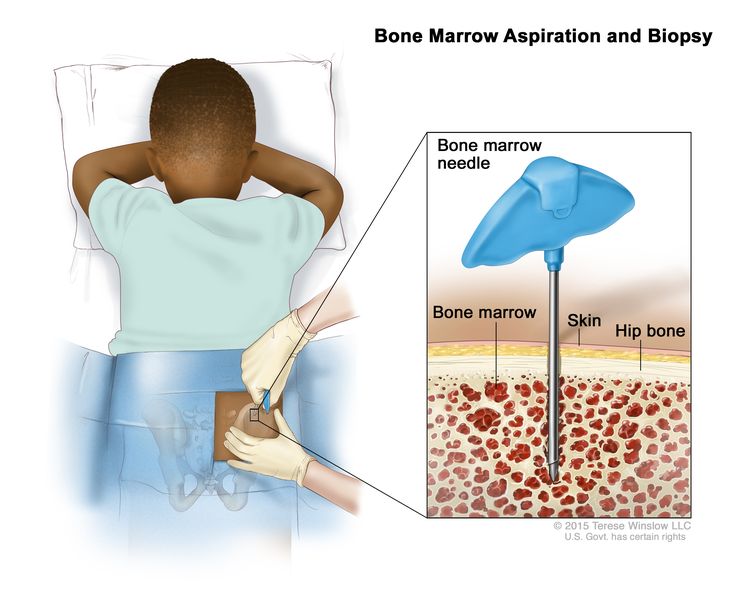 Soft Tissue Sarcoma Treatment - NCI