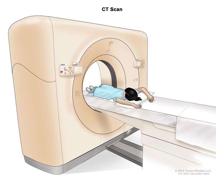 الفحص بالتصوير المقطعي المحوسب (CT) للبطن.  يظهر الرسم طفلاً مستلقياً على طاولة تنزلق عبر ماسح التصوير المقطعي المحوسب ، الذي يلتقط صوراً بالأشعة السينية لداخل البطن.