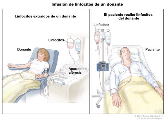 Infusión de linfocitos de un donante; (Panel 1): imagen de la extracción de linfocitos de un donante. Se extrae sangre de una vena del brazo del donante y se hace pasar la sangre por un aparato de aféresis que extrae los linfocitos. Luego, se devuelve la sangre al donante a través de una vena en el otro brazo. (Panel 2): el paciente recibe los linfocitos a través de un catéter colocado en el pecho.