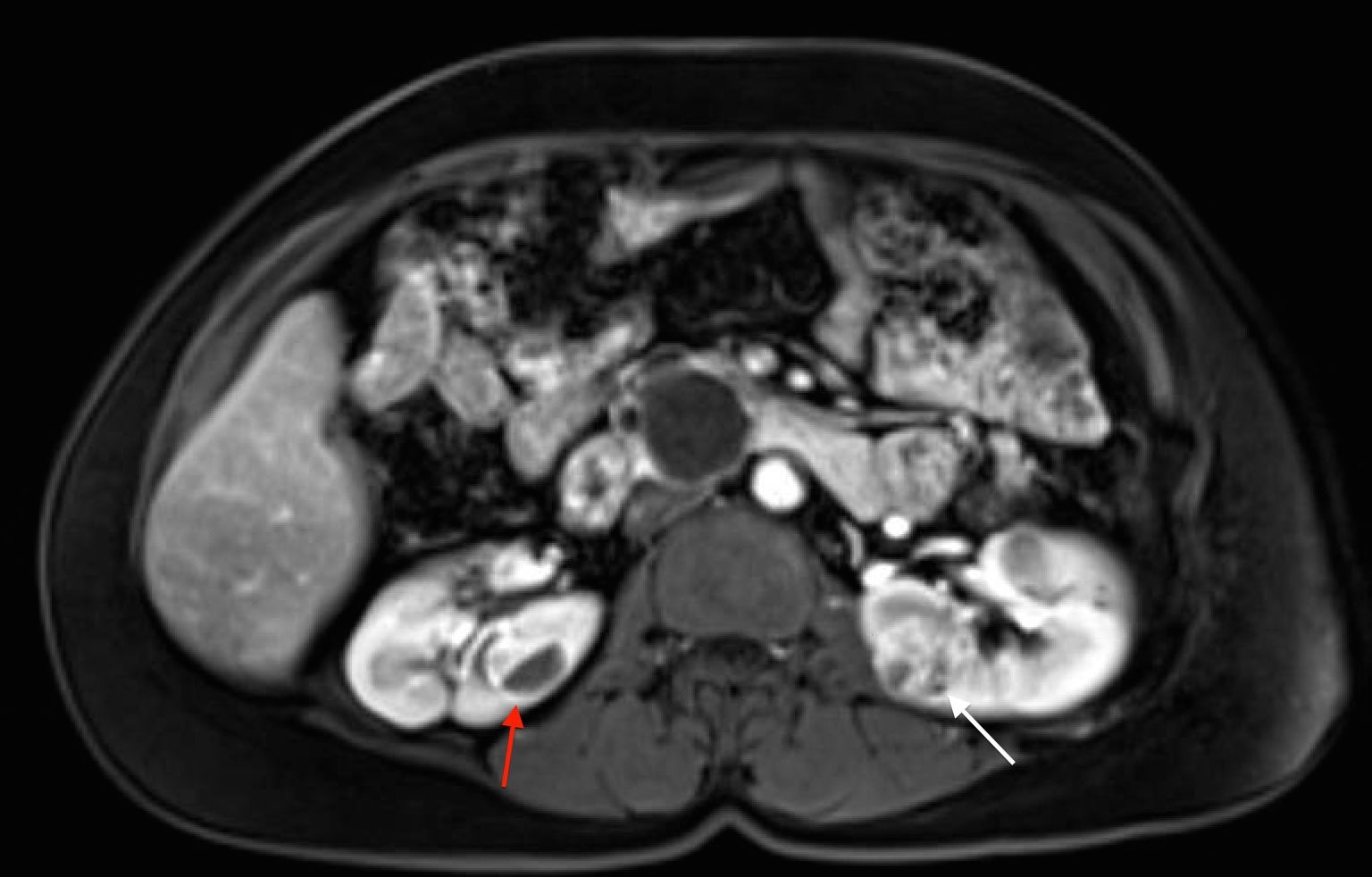 Axial view of an individual’s midsection showing tumors in both kidneys. The left kidney has a tumor with a dark cystic component and the right kidney has a predominantly solid tumor.