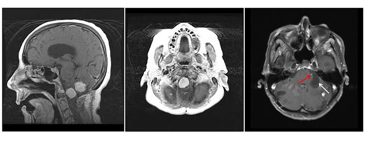 En la imagen se observan tres paneles. En el panel de la izquierda se muestra una vista sagital de dos lesiones prominentes de color claro en el tronco encefálico y el cerebelo. En el panel del medio se muestra una vista axial de una lesión prominente en el tronco encefálico. En el panel de la derecha se muestra una vista axial de una lesión en el cerebelo con un componente quístico que se ve como un área grande y oscura.