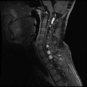 Sagittal view of an individual’s neck showing several light-colored lesions along the spinal cord.