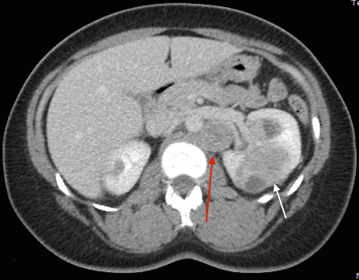 Axial view of an individual’s midsection showing tumors in both kidneys. The left kidney has a small tumor and the right kidney has a larger tumor. A retroperitoneal lymph node is shown beside the larger tumor.