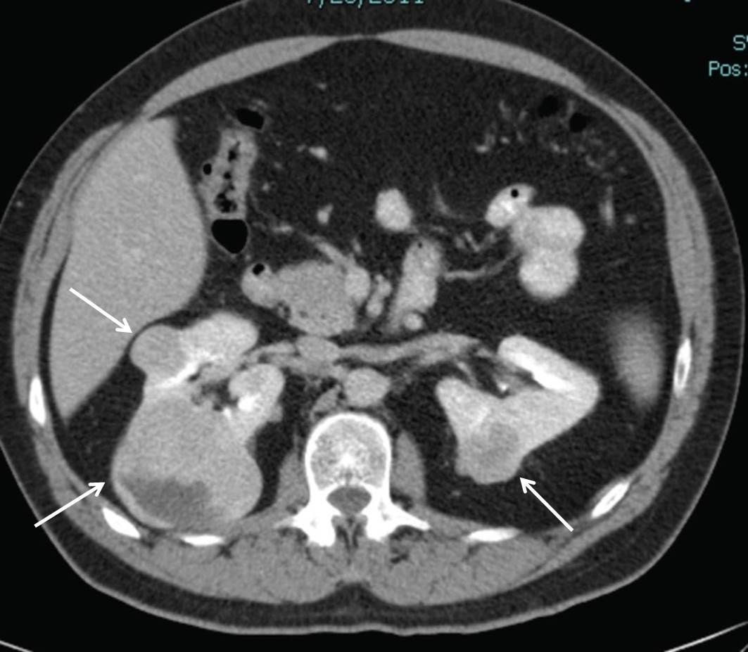 Axial view of an individual’s midsection showing two tumors in the left kidney and one tumor in the right kidney.