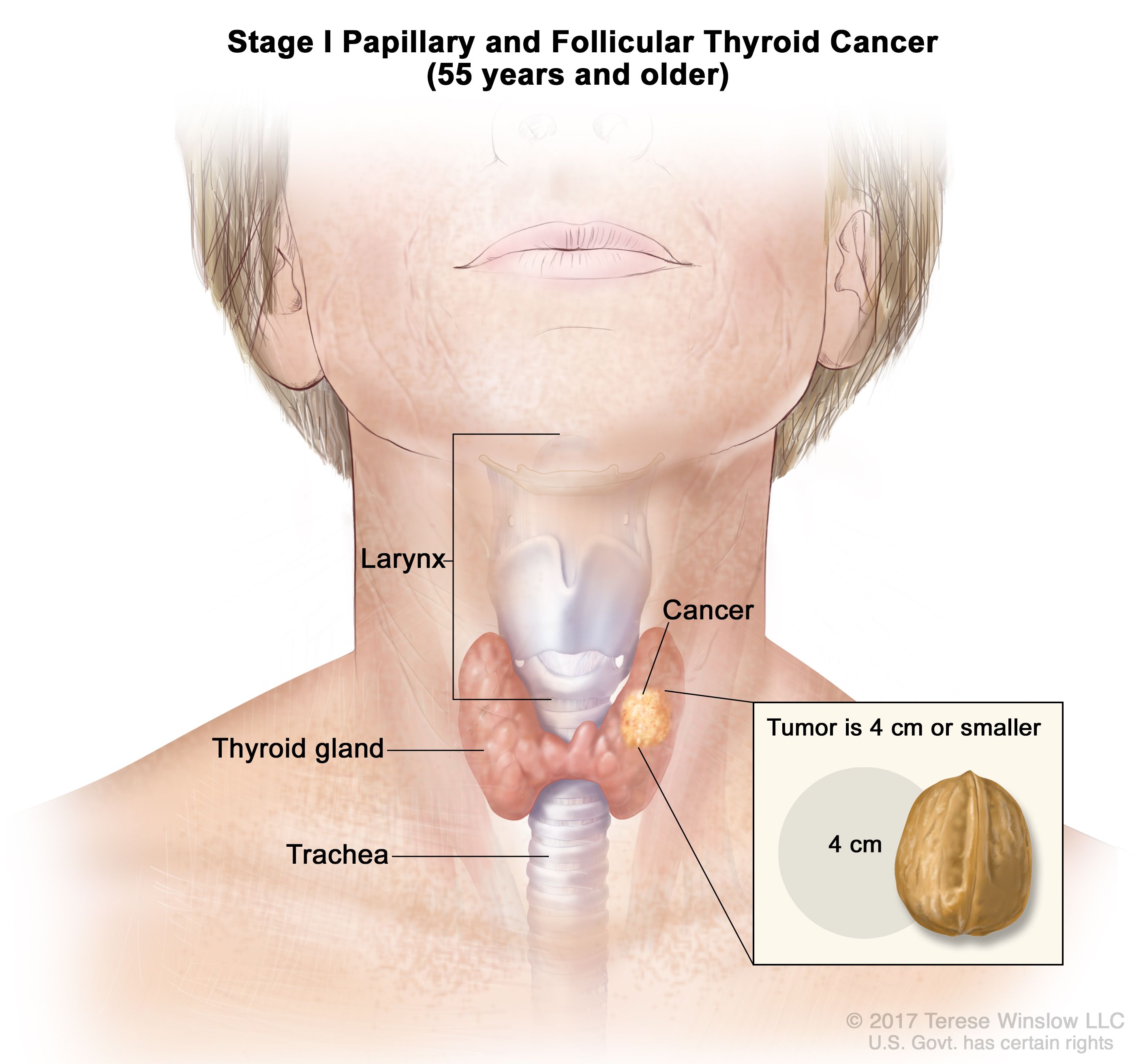 Cancerous Lumps On Neck