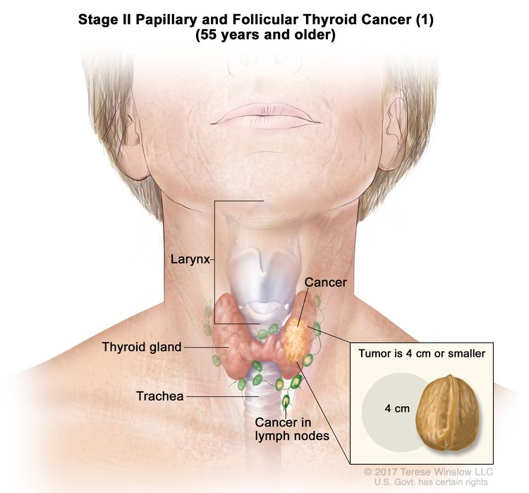 Stage II papillary and follicular thyroid cancer (1) in patients 55 years and older; drawing shows cancer in the thyroid gland and nearby lymph nodes. The tumor is 4 centimeters or smaller. An inset shows 4 centimeters is about the size of a walnut. Also shown are the larynx and trachea.