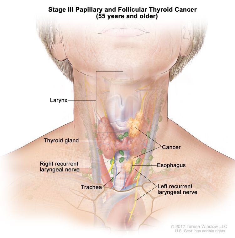 Stage III papillary and follicular thyroid cancer in patients 55 years and older; drawing shows cancer that has spread from the thyroid gland to the esophagus, the trachea, the larynx, and the left recurrent laryngeal nerve. Also shown is the right recurrent laryngeal nerve.