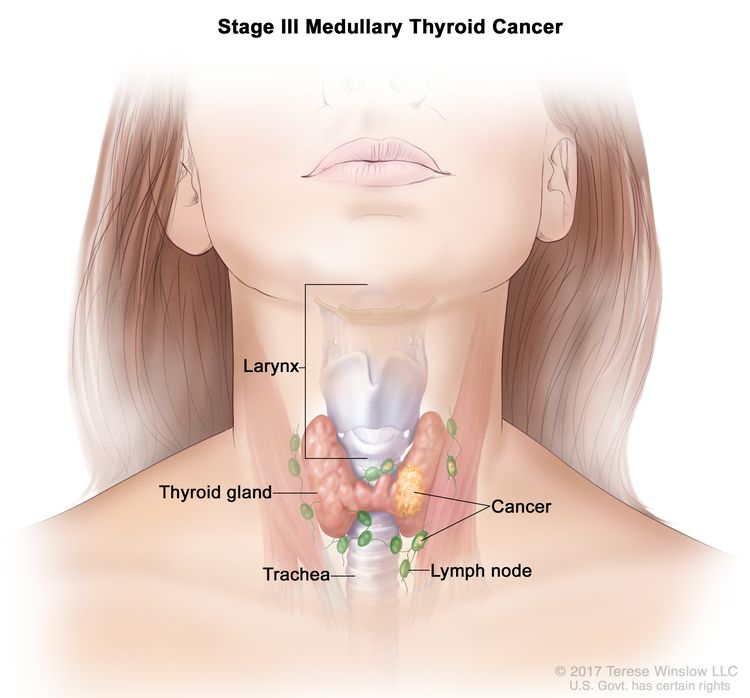 Stage III medullary thyroid cancer; drawing shows cancer in the thyroid gland and in nearby lymph nodes. Also shown are the trachea and larynx.