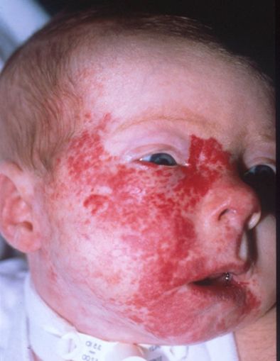 Photograph showing a large segmental hemangioma (plaque-like) in a bearded distribution on the right side of the face.