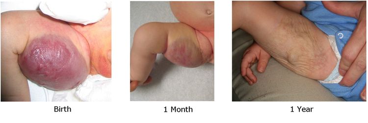 Photographs showing a cutaneous congenital hemangioma on the inner right thigh at birth (left panel), 1 month (middle panel), and 1 year (right panel).