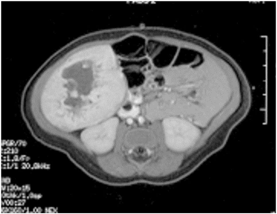 単一の肝病変（肝内先天性血管腫）のMRI画像。
