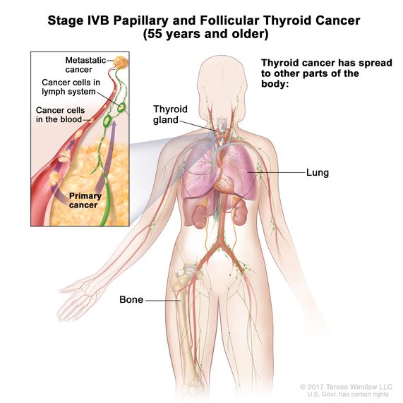 Papillary Thyroid Cancer Spread To Lungs