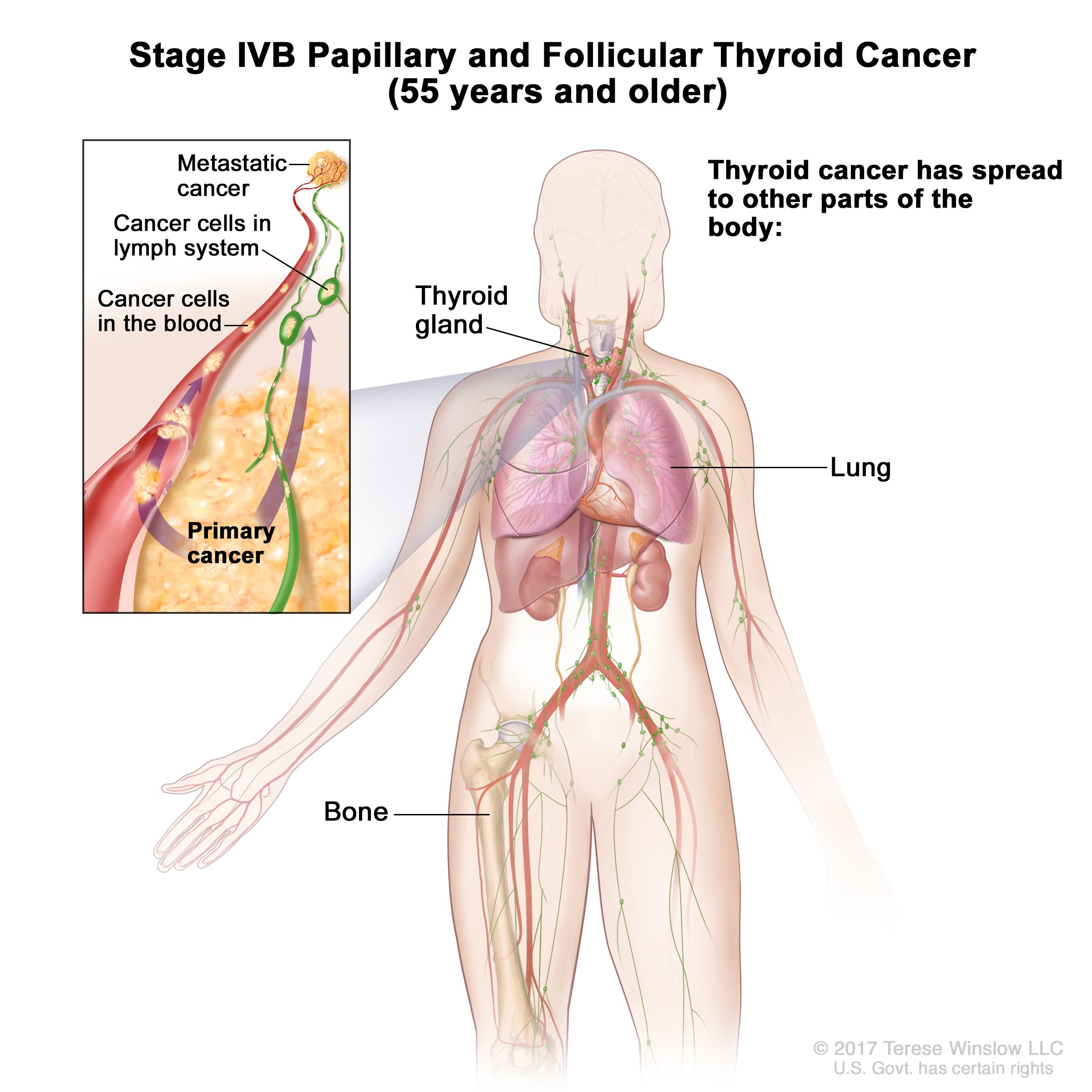 Where Does Papillary Thyroid Cancer Spread To