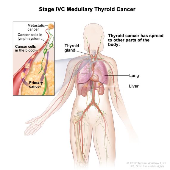 Definition Of Stage Iv Medullary Thyroid Cancer Nci Dictionary Of Cancer Terms National Cancer Institute