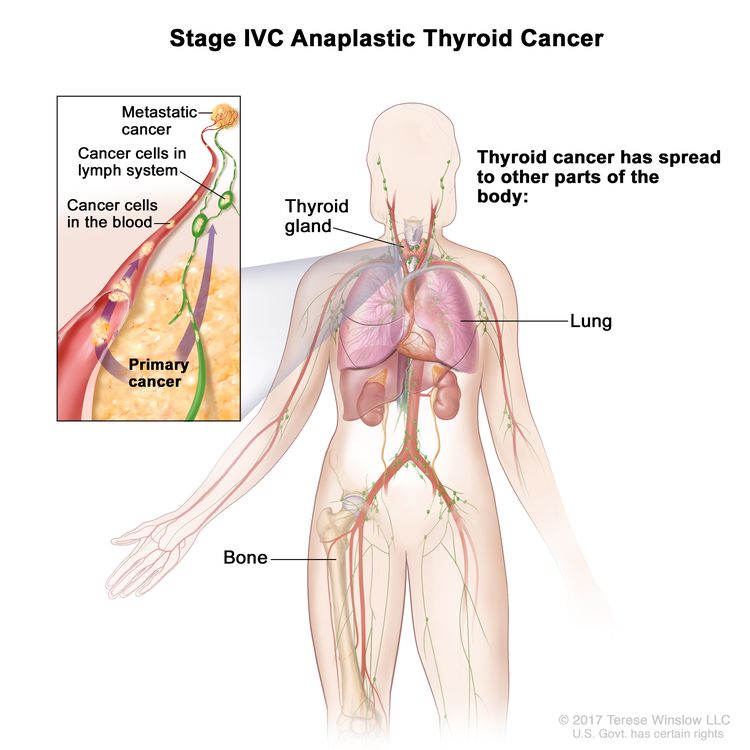 Stage IVC anaplastic thyroid cancer; drawing shows other parts of the body where thyroid cancer may spread, including the lung and bone. An inset shows cancer cells spreading from the thyroid, through the blood and lymph system, to another part of the body where metastatic cancer has formed.