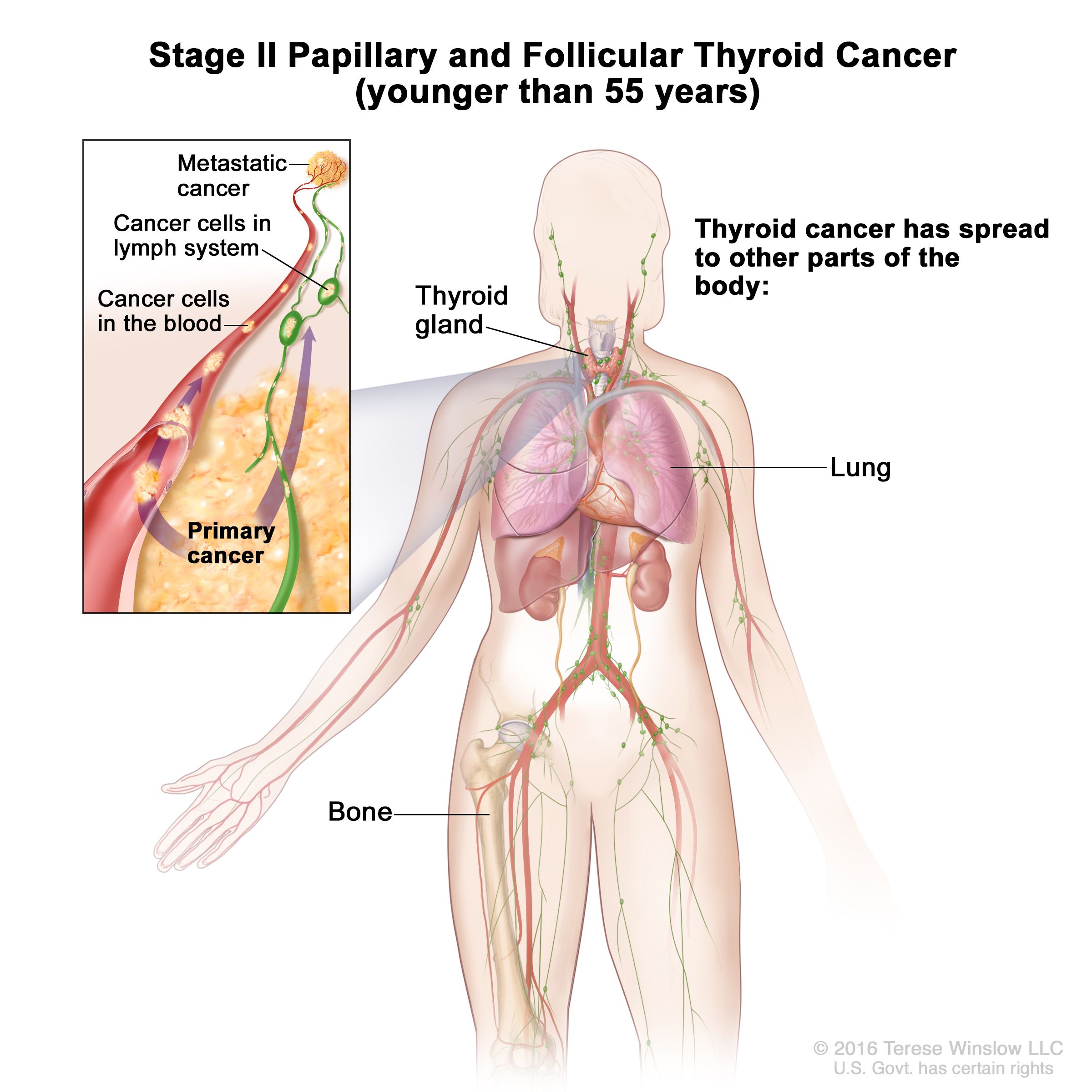 metastatic cancer glands