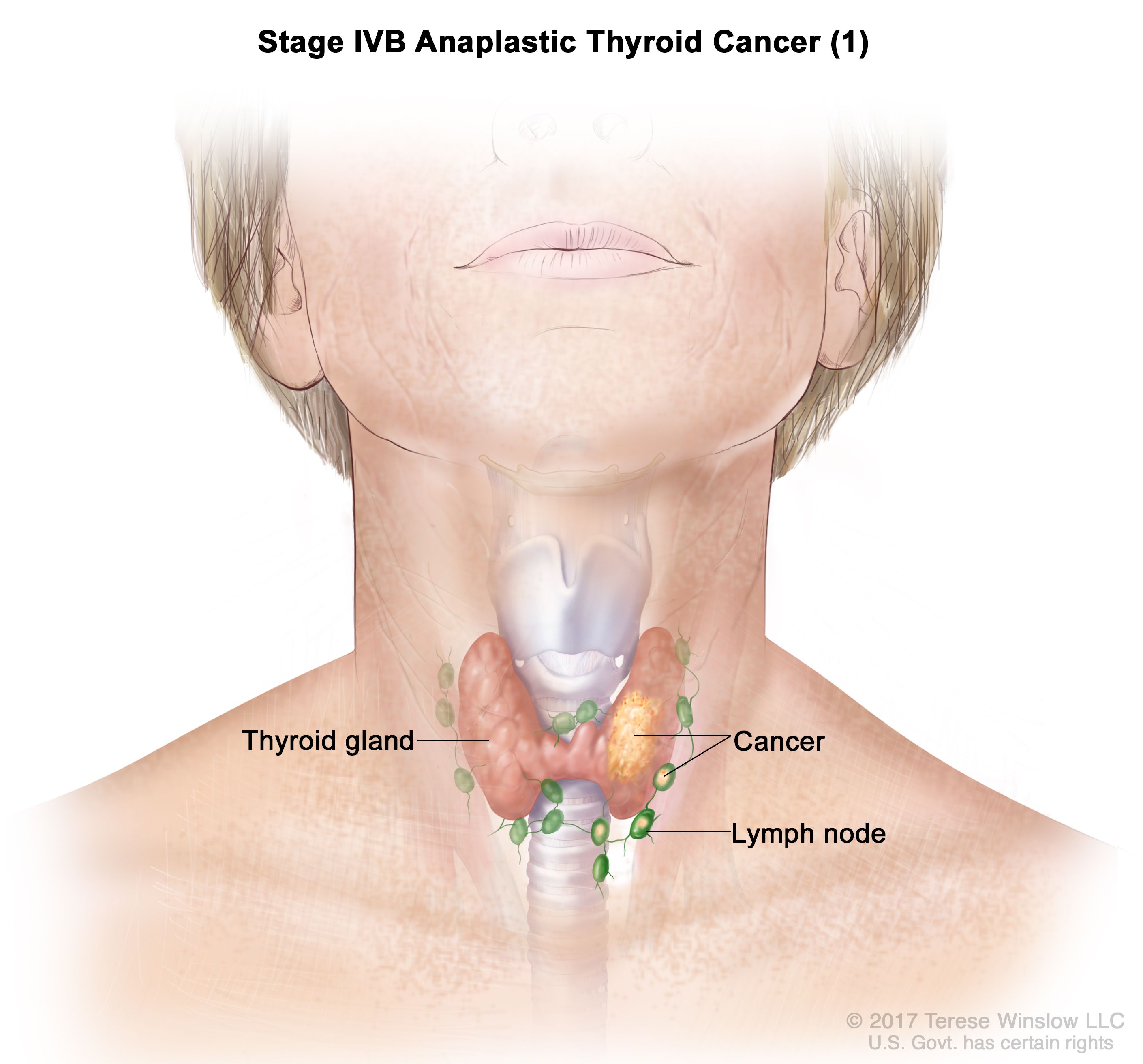 Thyroid Cancer Treatment PDQ Patient Version NCI