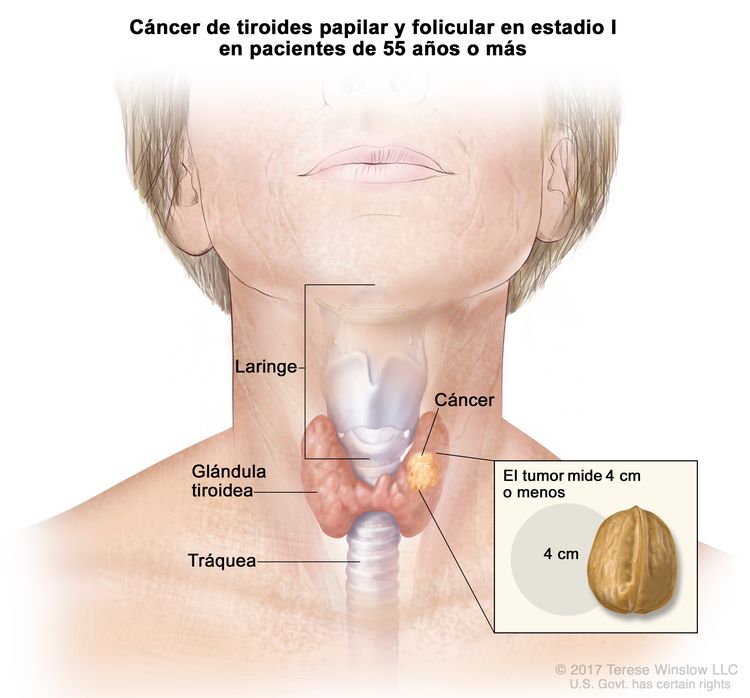 Cáncer de tiroides papilar y folicular en estadio I en pacientes de 55 años o más. En la imagen se muestra el cáncer en la glándula tiroidea y el tumor mide 4 cm o menos. En el recuadro se observa que 4 cm es casi del tamaño de una nuez. También se muestran la laringe y la tráquea.