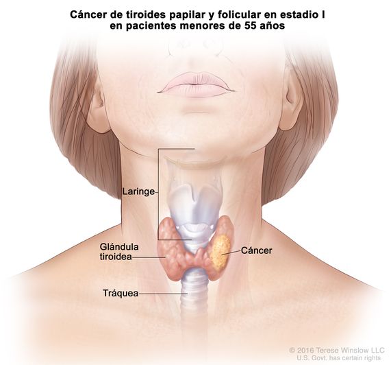Cáncer de tiroides papilar y folicular en estadio I en pacientes menores de 55 años. En la imagen se muestra cáncer en la glándula tiroidea. También se muestran la laringe y la tráquea.
