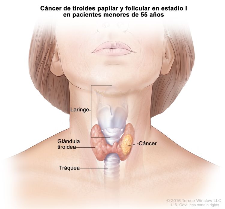 Cáncer de tiroides papilar y folicular en estadio I en pacientes menores de 55 años. En la imagen se muestra cáncer en la glándula tiroidea. También se muestran la laringe y la tráquea.