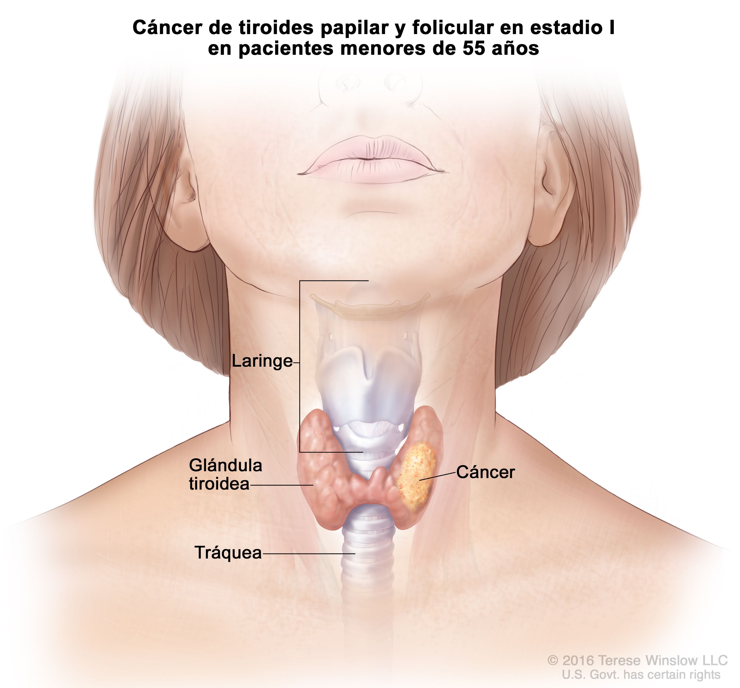 Informații despre Cancerui Tiroidian