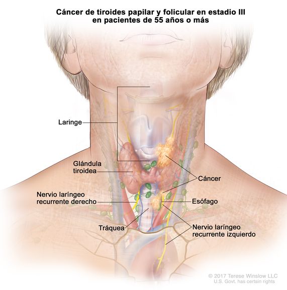 Cáncer de tiroides papilar y folicular en estadio III en pacientes de 55 años o más. En la imagen se muestra cáncer que se diseminó desde la glándula tiroidea hasta el esófago, la tráquea, la laringe y el nervio laríngeo recurrente izquierdo. También se muestra el nervio laríngeo recurrente derecho.