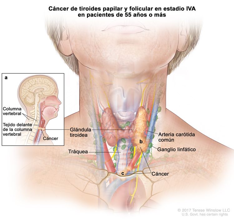 Cáncer de tiroides papilar y folicular en estadio IVA en pacientes de 55 años o más. En la imagen se muestra que el cáncer a) se diseminó al tejido delante de la columna vertebral (recuadro), b) rodeó la arteria carótida común y c) rodeó los vasos sanguíneos del área entre los pulmones. También se muestran la glándula tiroidea, la tráquea y los ganglios linfáticos.