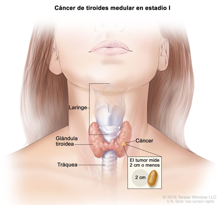 Cáncer de tiroides medular en estadio I. En la imagen se muestra cáncer en la glándula tiroidea y el tumor que mide 2 cm o menos. En el recuadro se observa que 2 cm es casi del tamaño de un maní. También se muestran la laringe y la tráquea.