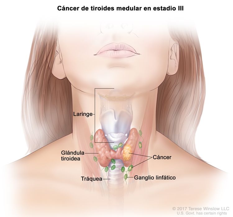 Cáncer de tiroides medular en estadio III. En la imagen se muestra cáncer en la glándula tiroidea y en los ganglios linfáticos cercanos. También se muestran la tráquea y la laringe.