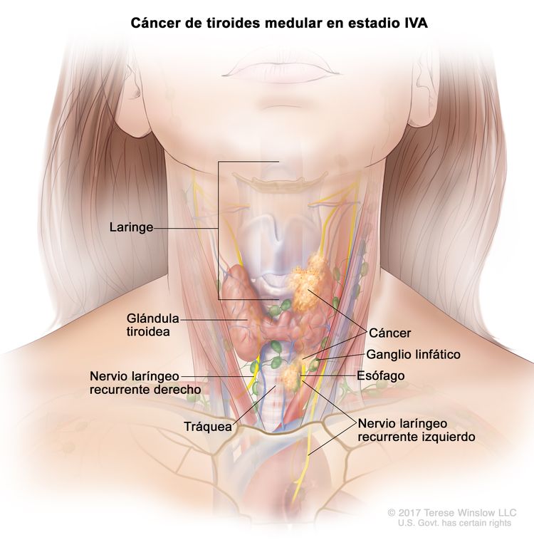Cáncer de tiroides medular en estadio IVA. En la imagen se muestra cáncer en la glándula tiroidea, la laringe, el esófago, el nervio laríngeo recurrente izquierdo, la tráquea y un ganglio linfático de un lado del cuello. También se muestra el nervio laríngeo recurrente derecho.