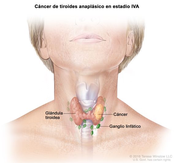 Cáncer de tiroides anaplásico en estadio IVA. En la imagen se muestra el cáncer en la glándula tiroidea. También se muestran los ganglios linfáticos.