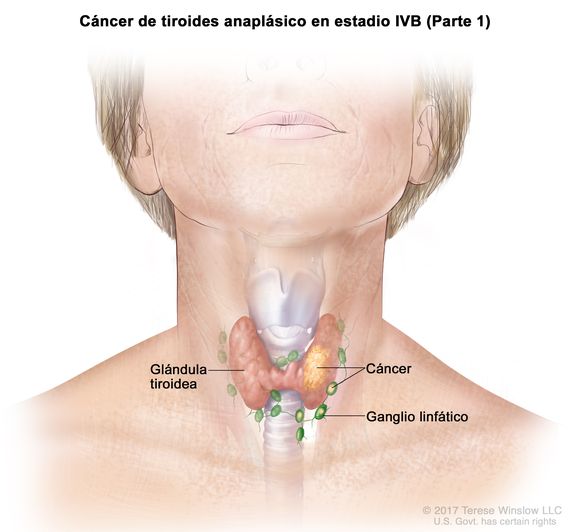 Cáncer de tiroides anaplásico en estadio IVB (Parte 1). En la imagen se muestra el cáncer en la glándula tiroidea y los ganglios linfáticos cercanos.
