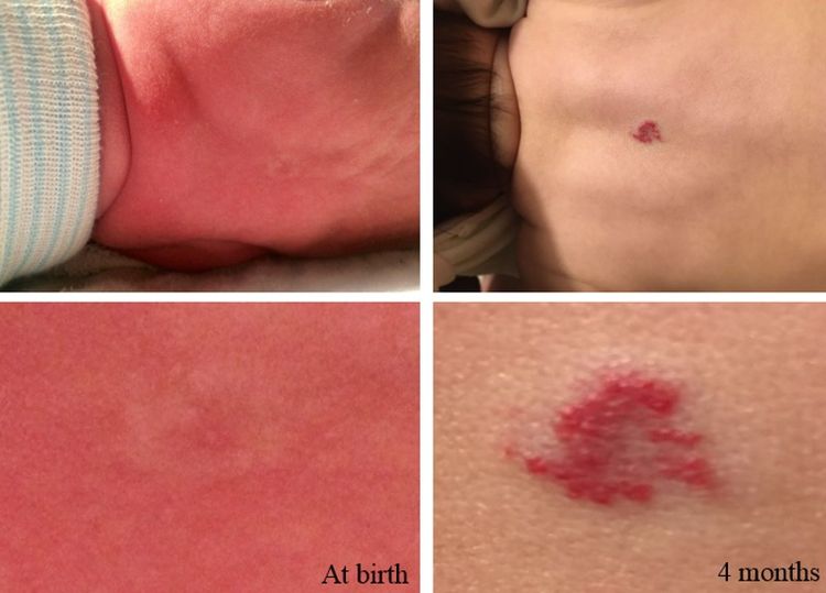 Photos showing an infantile hemangioma premonitory mark; the photos on the left show a precursor lesion (faint color with halo). The photos on the right show a hemangioma after proliferation (slightly raised with a brighter central color).