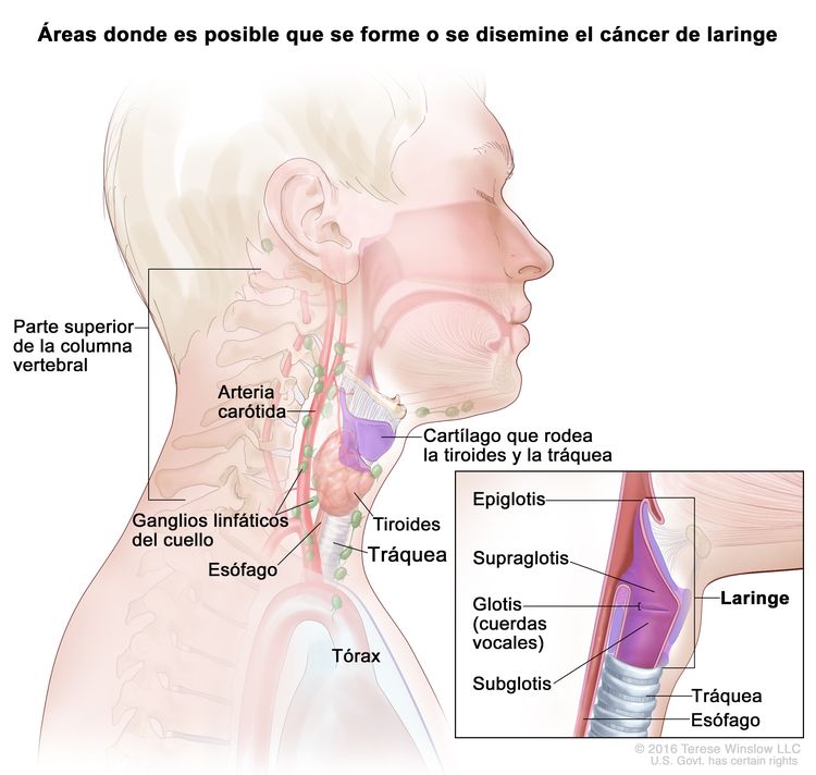 En la imagen se observan las áreas en donde es posible que se forme o disemine el cáncer de laringe: la supraglotis, la glotis (cuerdas vocales), la subglotis, la tiroides, la tráquea y el esófago. También se muestran la epiglotis, la parte superior de la columna vertebral, la arteria carótida, el cartílago que rodea la tiroides y la tráquea, los ganglios linfáticos del cuello, y el tórax.