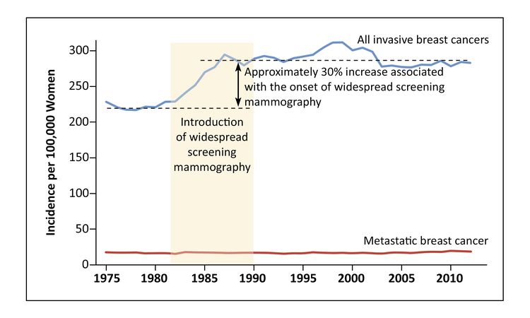 Chart showing the temporal relationship between the introduction of screening mammography and increased incidence of invasive breast cancer.