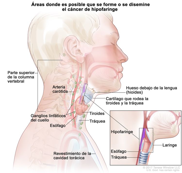 En la imagen se observan las áreas en donde es posible que se forme o disemine el cáncer de hipofaringe: el hueso debajo de la lengua (hioides), el cartílago que rodea la tiroides y la tráquea, la tiroides, la tráquea y el esófago. También se muestran la parte superior de la columna vertebral, la arteria carótida, los ganglios linfáticos del cuello y el revestimiento de la cavidad torácica. En un recuadro se muestra un corte transversal de la hipofaringe, la laringe, el esófago y la tráquea.