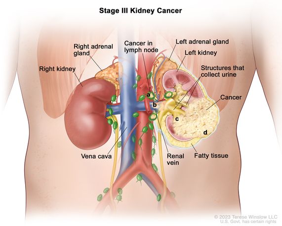 Definition Of Stage Iii Kidney Cancer Nci Dictionary Of Cancer Terms National Cancer Institute