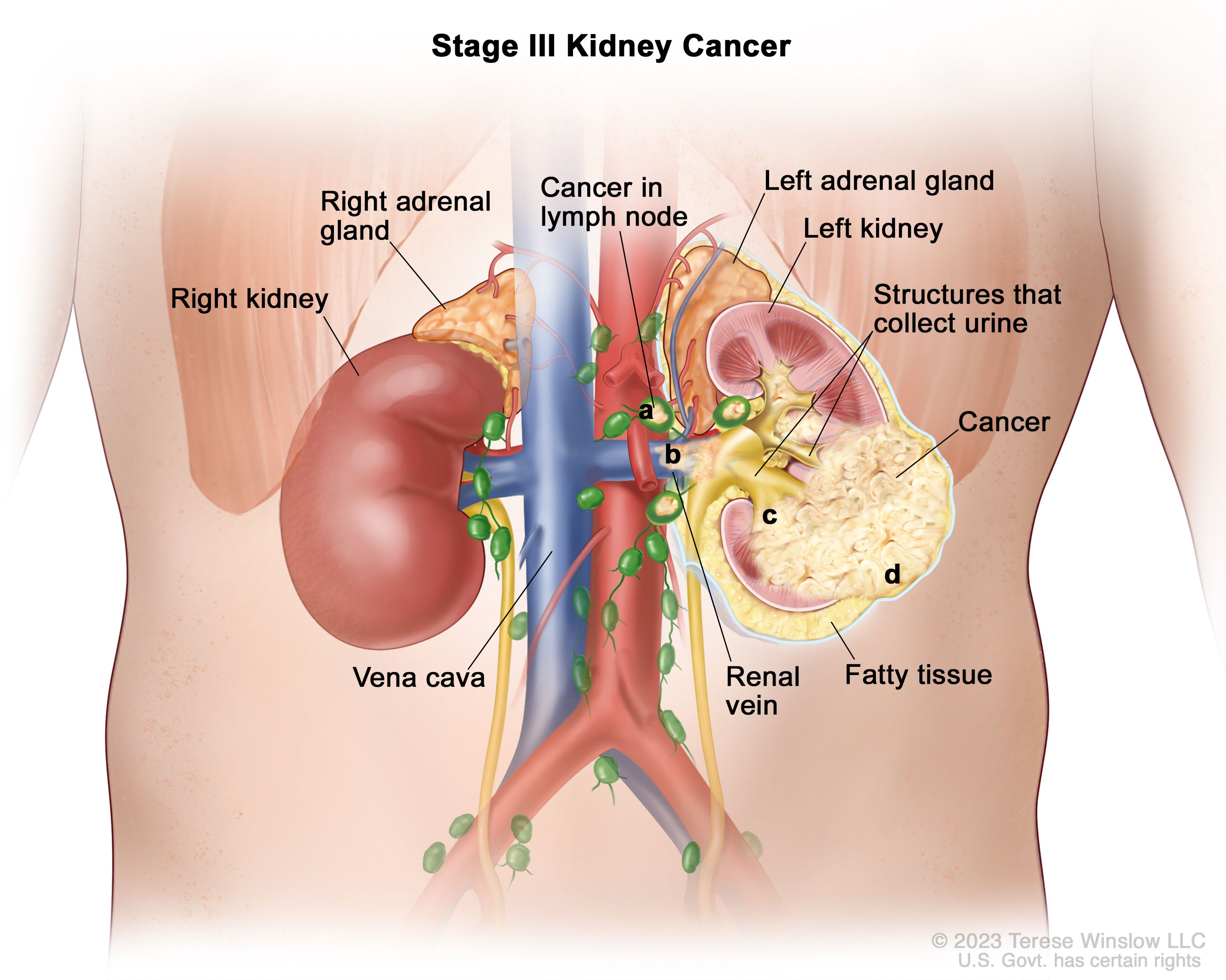 kidney cancer stages