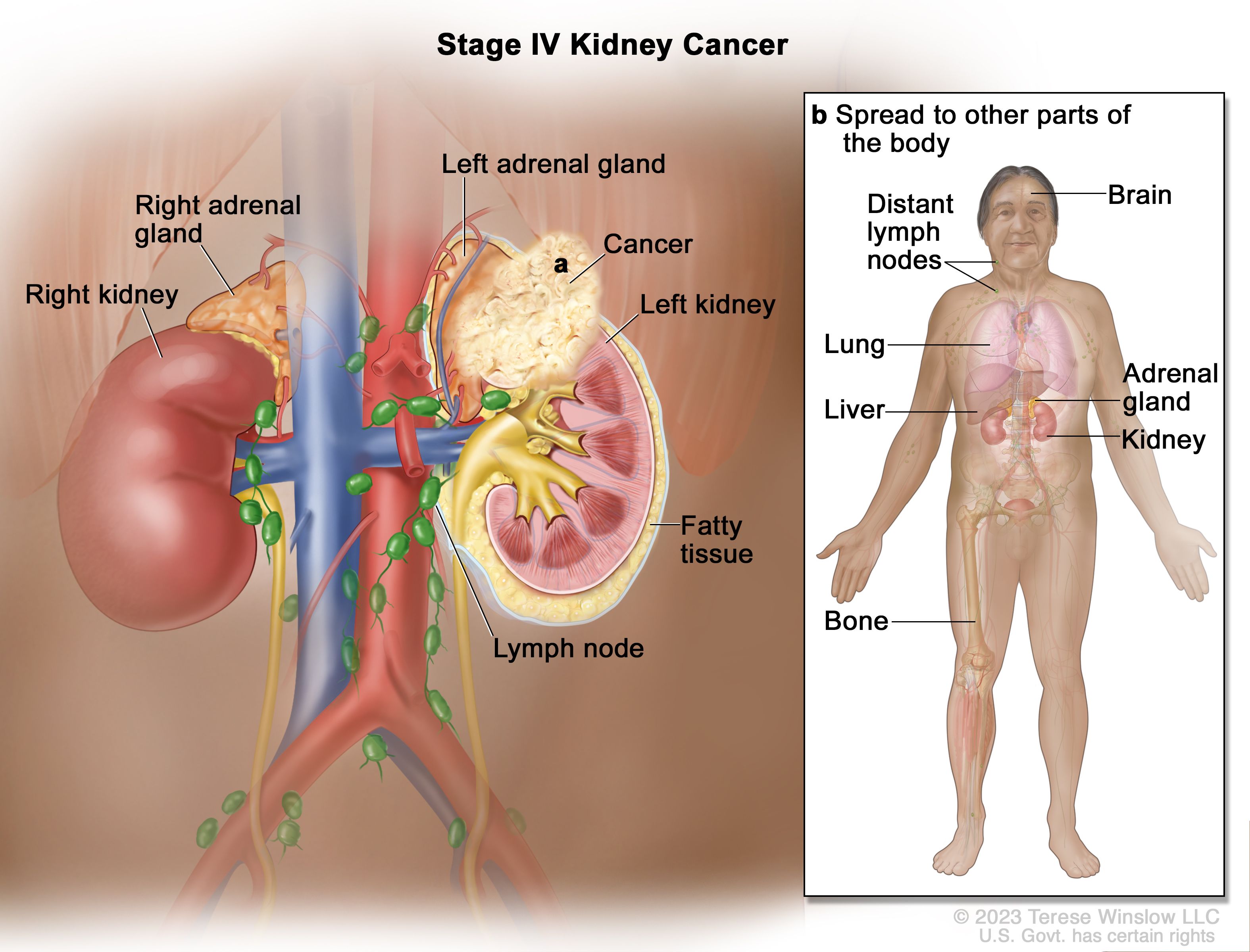 renal-cell-cancer-treatment-pdq-patient-version-nci