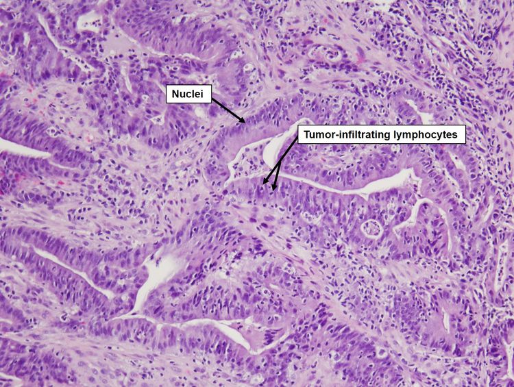 Histopathology slide of a colorectal tumor under a microscope, showing lymphocytes and cell nuclei in the tumor.