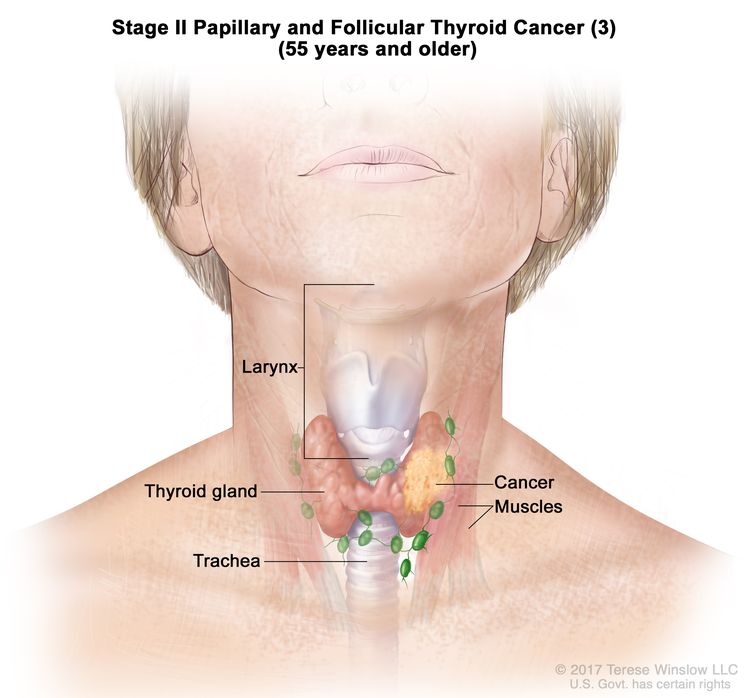 Stage II papillary and follicular thyroid cancer (3) in patients 55 years and older; drawing shows cancer in the thyroid gland and nearby muscles in the neck. Also shown are the larynx and trachea.