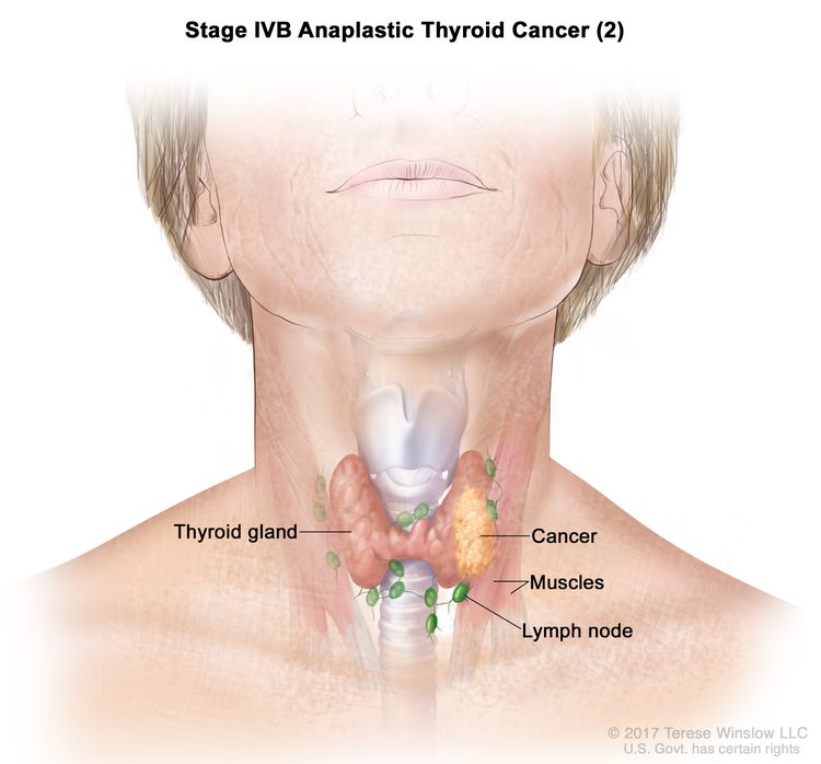 Thyroid Cancer UCSF Department Of Surgery