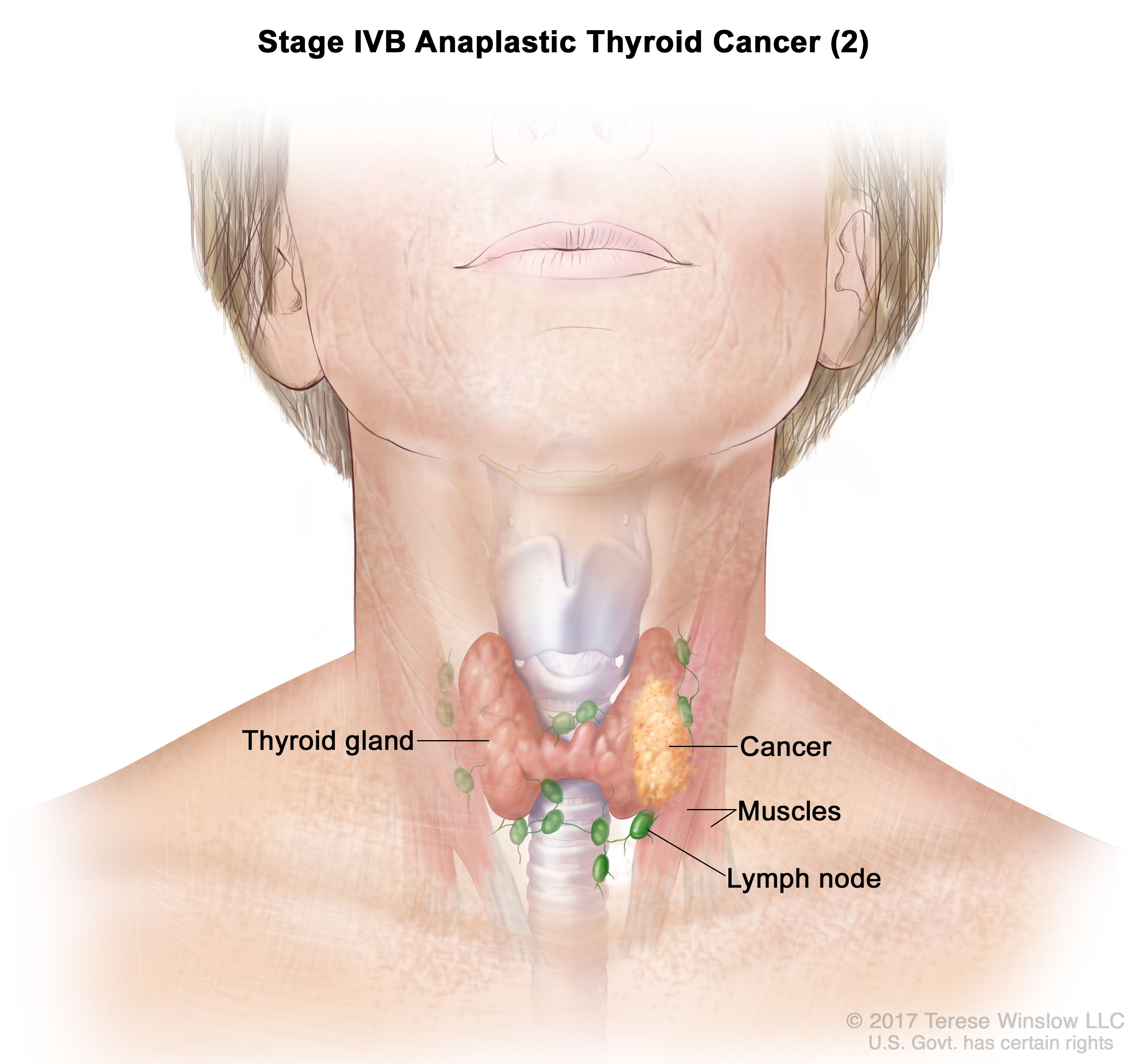 Thyroid Cancer Treatment Adult PDQ Health Professional Version 