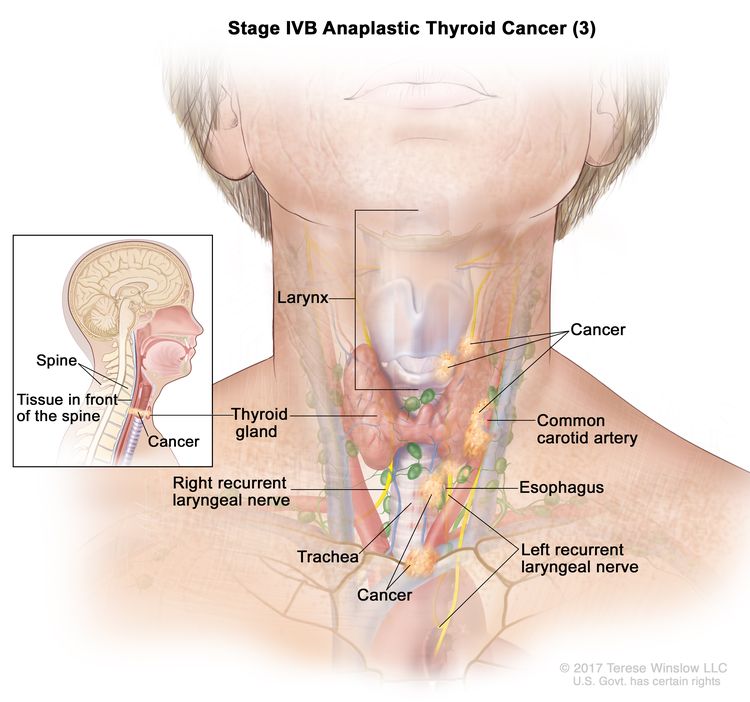 Stage IVB anaplastic thyroid cancer (3); drawing shows cancer in the thyroid gland and in the esophagus, the trachea, the larynx, the left recurrent laryngeal nerve, and the tissue in front of the spine (inset). Cancer has also surrounded the common carotid artery and the blood vessels in the area between the lungs. Also shown is the right recurrent laryngeal nerve.