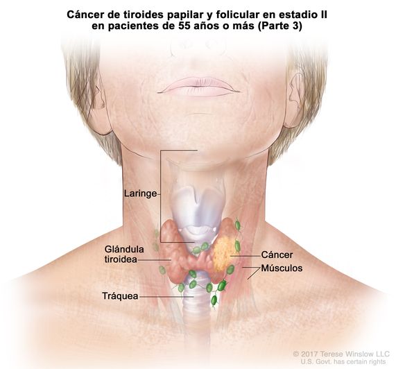 Cáncer de tiroides papilar y folicular en estadio II en pacientes de 55 años o más (Parte 3). En la imagen se muestran el cáncer en la glándula tiroidea y los músculos cercanos del cuello. También se muestran la laringe y la tráquea.