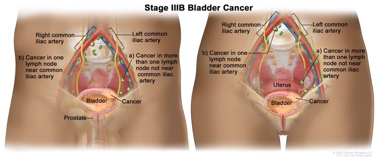 Two-panel drawing showing stage IIIB bladder cancer in a male (left panel) and a female (right panel); both panels show cancer in the bladder and in (a) more than one lymph node in the pelvis that is not near the common iliac artery and (b) one lymph node near the common iliac artery. Also shown are the right and left common iliac arteries.