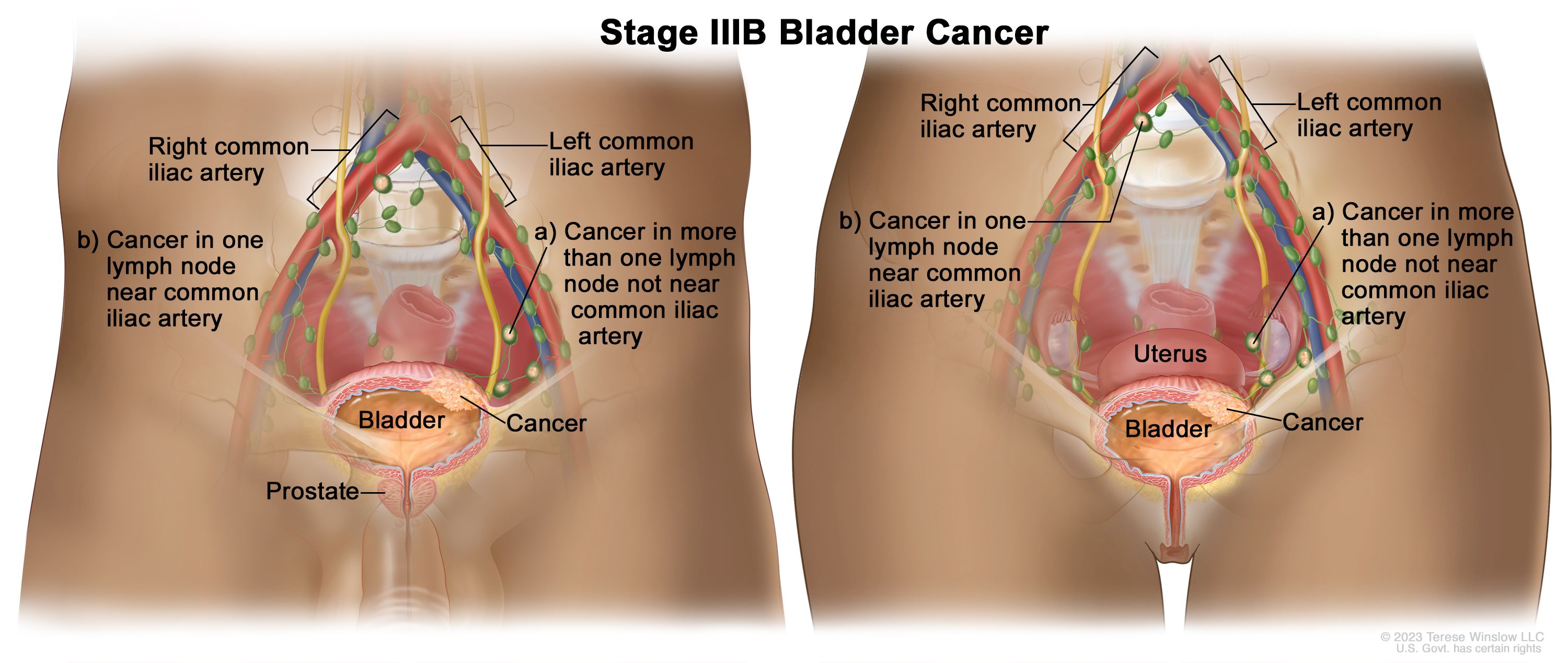 Cancer de la vessie de stade IIIB