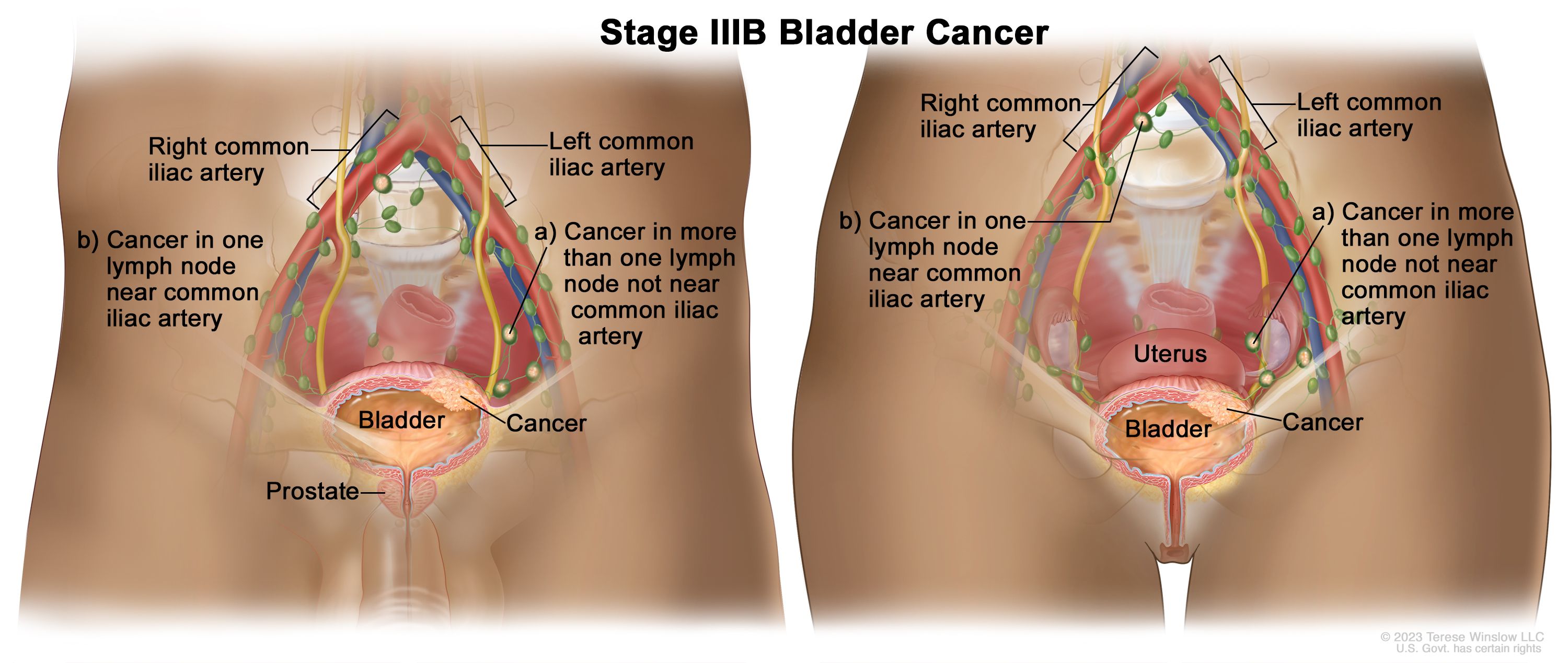 Table], Table 6. Anatomic Stage/Prognostic Groupsa,b - PDQ Cancer