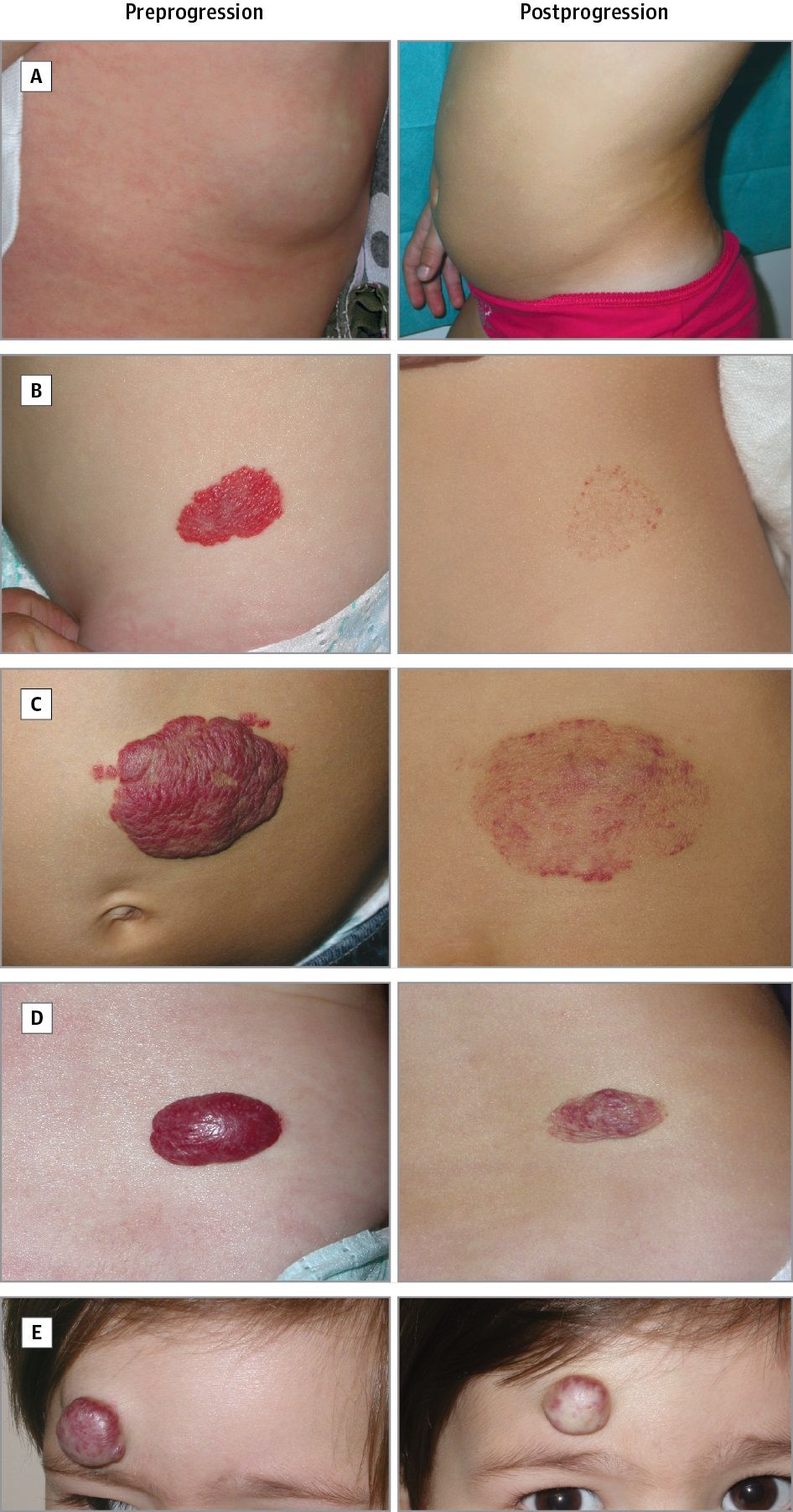 Photographs showing different types of hemangioma sequelae, pre-progression and post-progression.